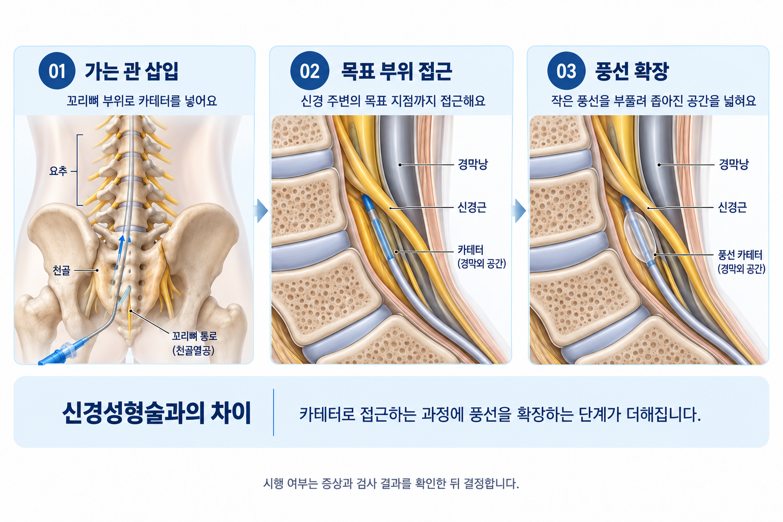 카테터 삽입, 목표 부위 접근, 풍선 확장 과정을 설명한 그림